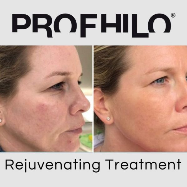 Profhilo-3 Profhilo 3